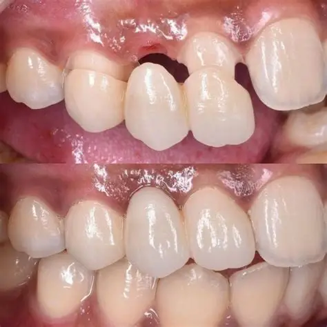 Crowns & Bridges Before & After